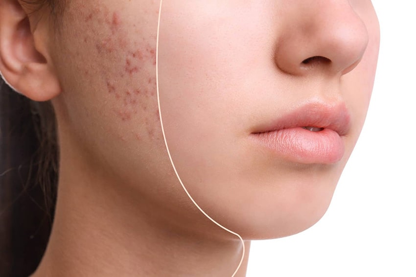 Facial Anti-Acné