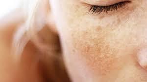 Facial Anti-Manchas